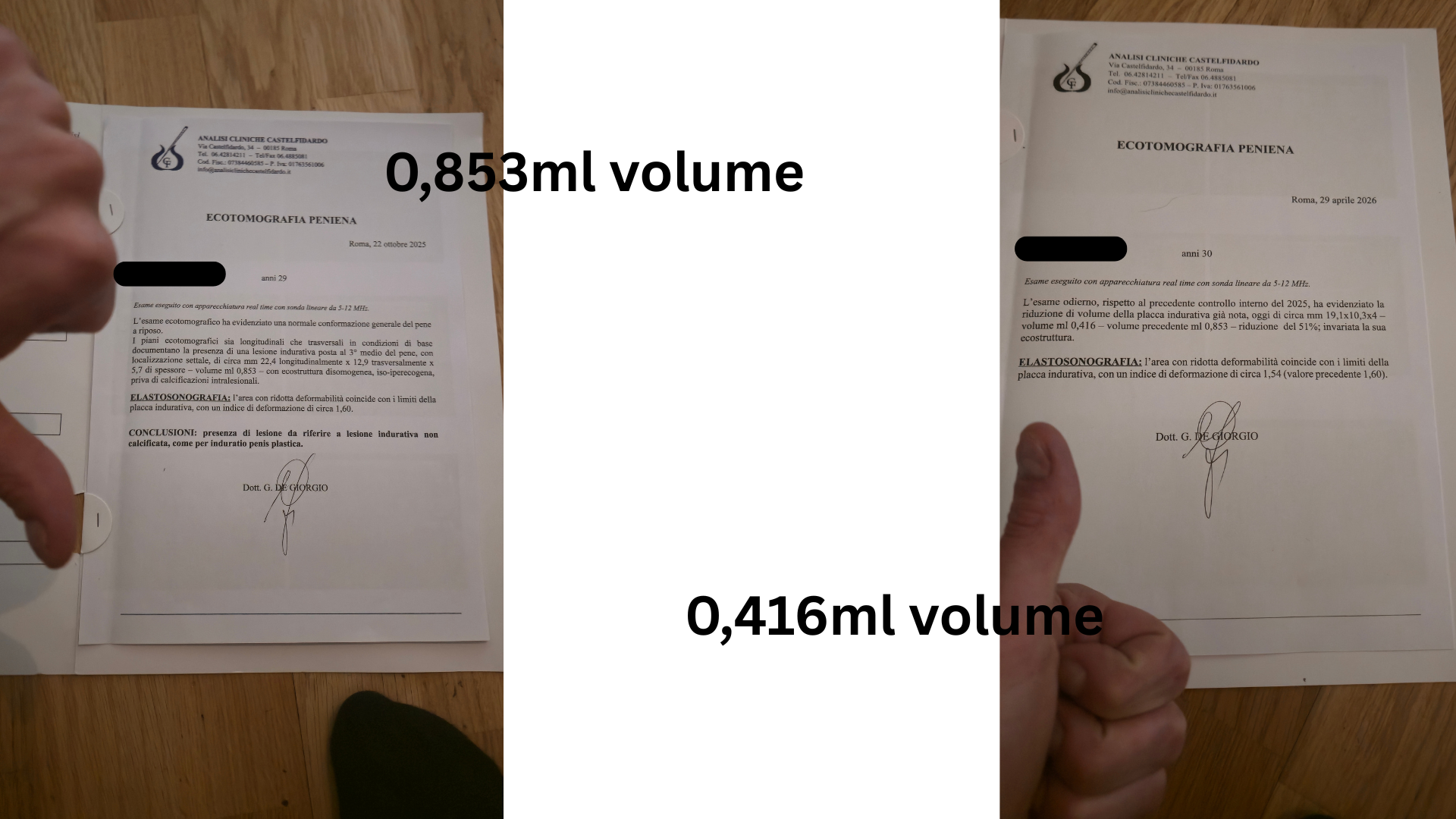 Two clinical ultrasonography reports issued in Rome. The earlier report records a plaque volume of 0.853 ml; the later report records 0.416 ml, a 51% reduction.